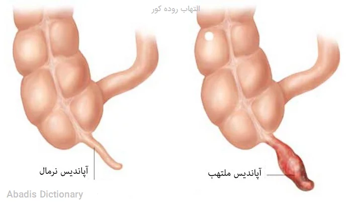 التهاب روده کور